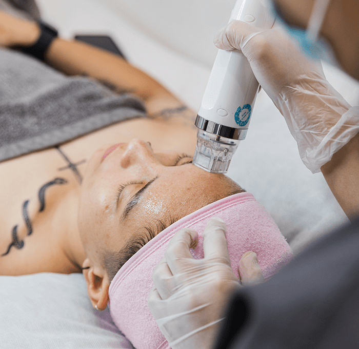 Fractional RF MICRONEEDLING + Facial